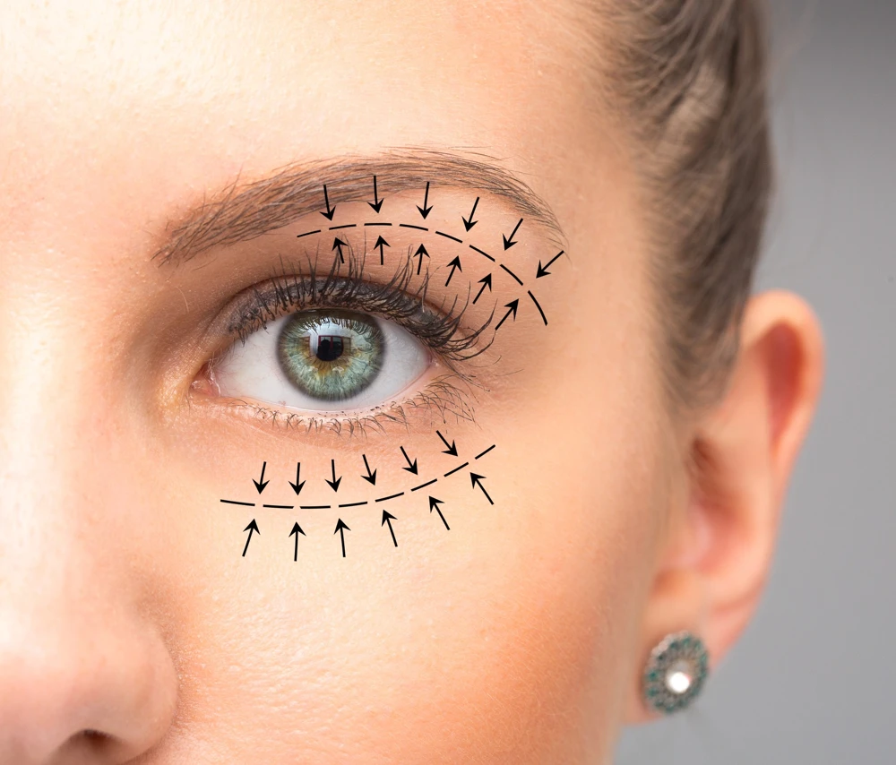 Imagen ilustrativa de blefaroplastia