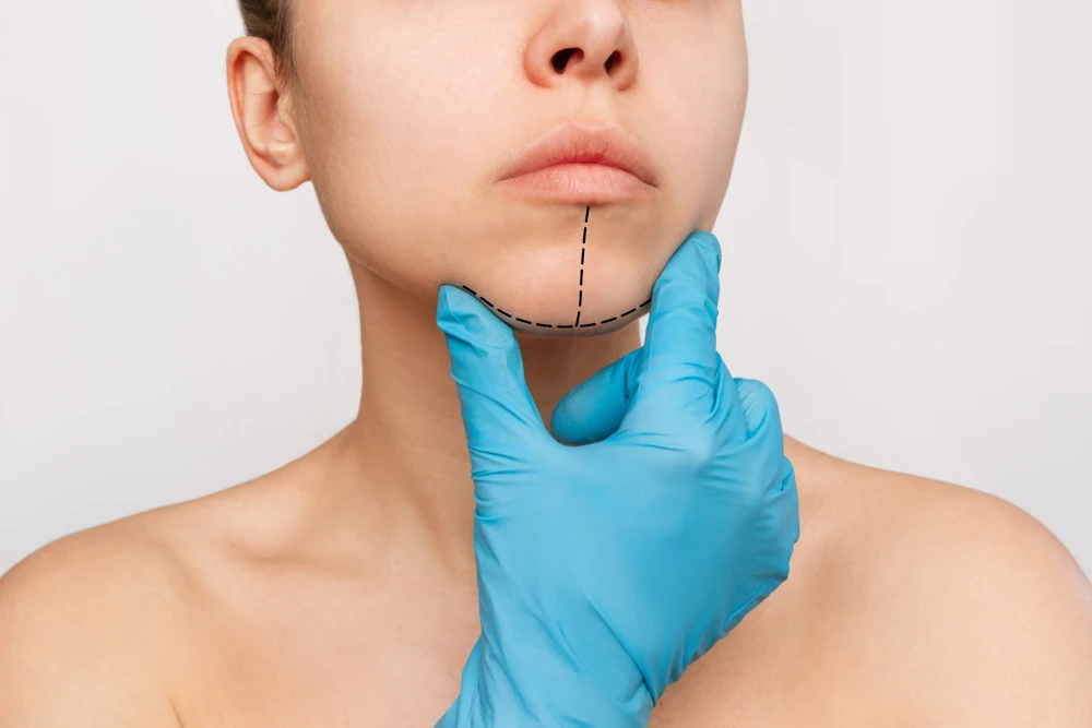 Imagen ilustrativa de mentoplastia