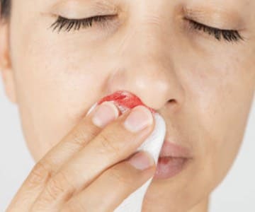 Control de epistaxis